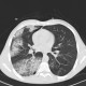 Alveolar lung edema, unilateral: CT - Computed tomography